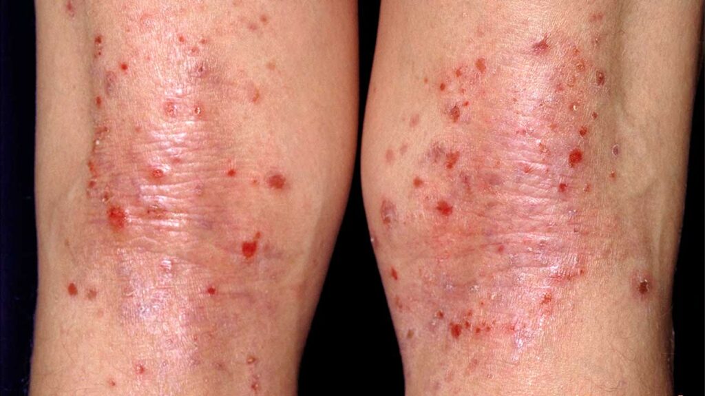 Red Spots On Legs Causes Pictures Including Small Itchy Non Itchy 