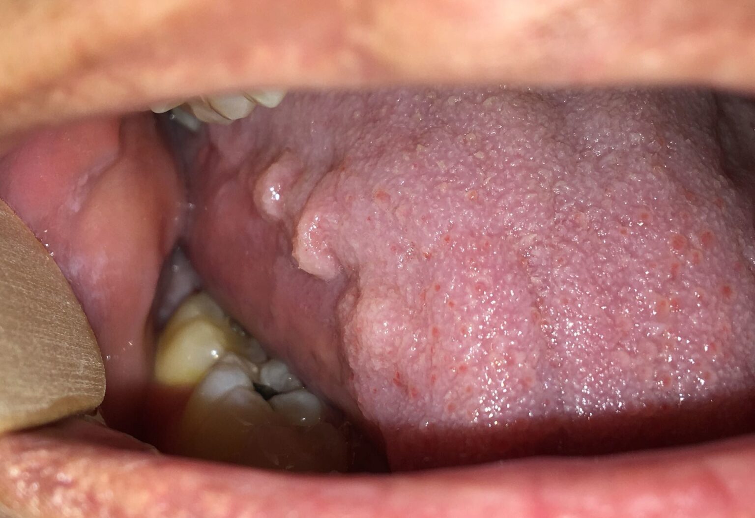 Scalloped Tongue Causes, Pictures, Hypothyroid, Diagnosis & Treatment