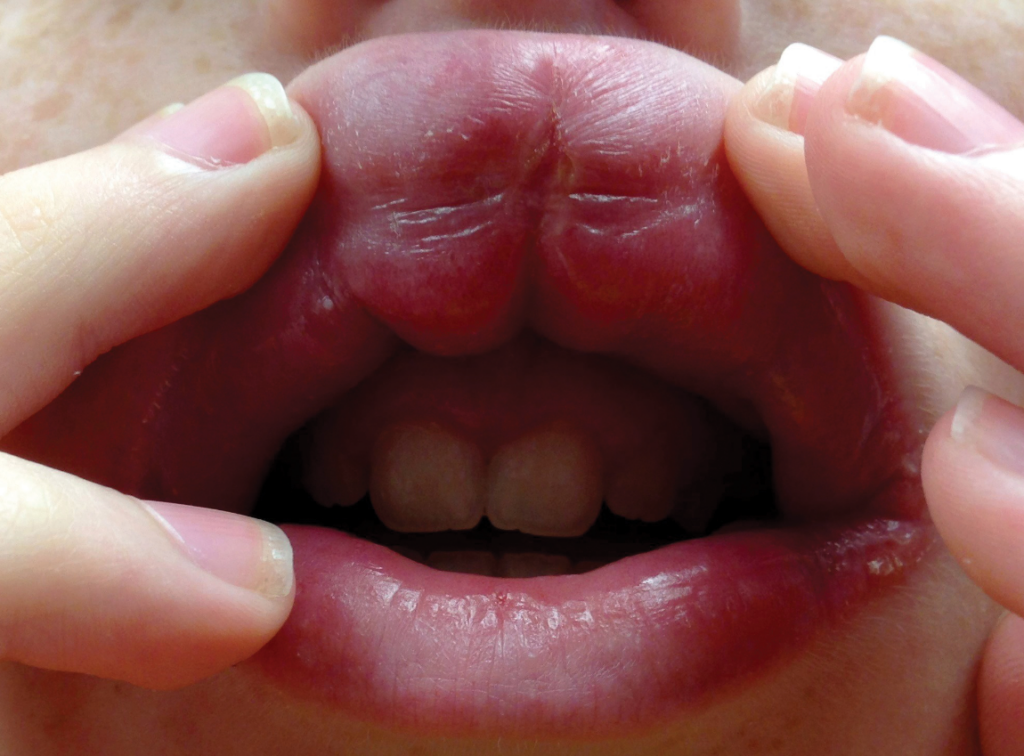 Lip Tie in Baby, Adults, Upper Lip Symptoms, Pictures