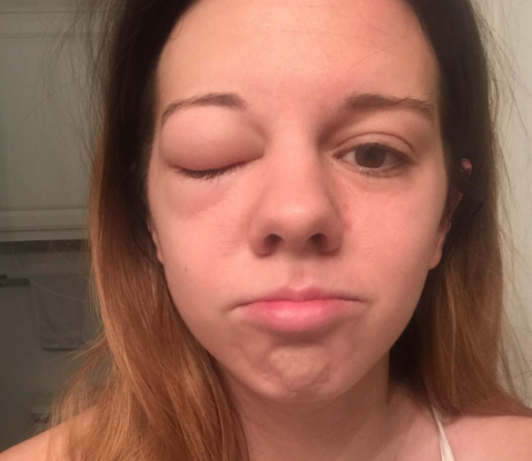 Swollen Lip Causes, Why Is My Lip Swollen – Allergies, Trauma, Sores