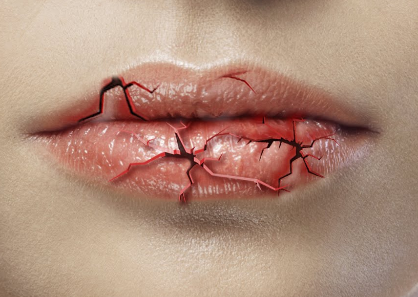 What Causes Chapped Lips.