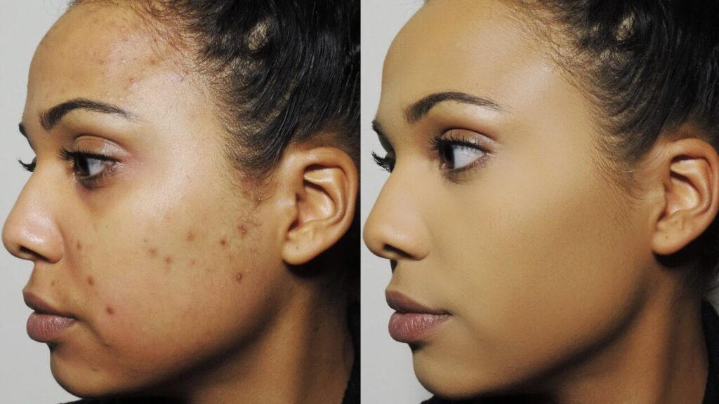 how-to-get-rid-of-dark-spots-on-your-face-with-9-easy-tips-bellatory