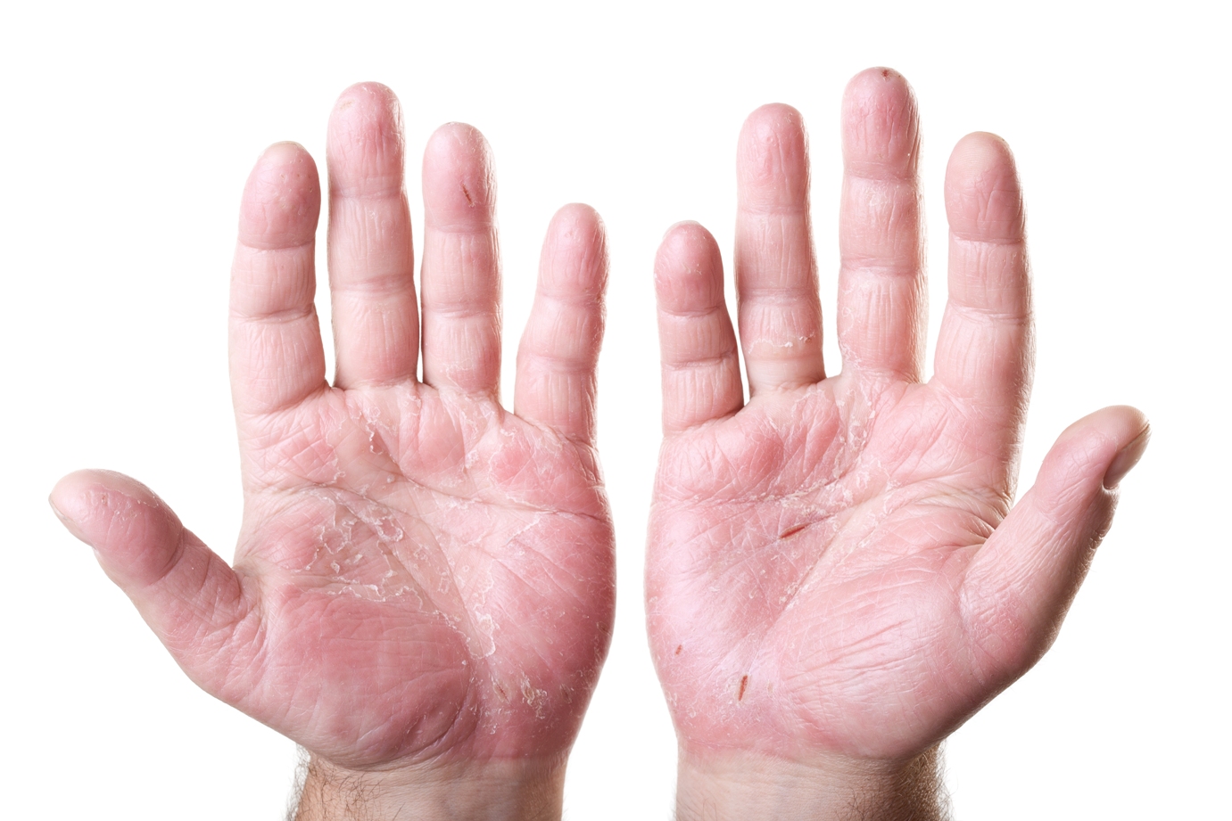 Itchy Palms Causes, Symptoms, Meaning Superstitions, Relief Remedies ...