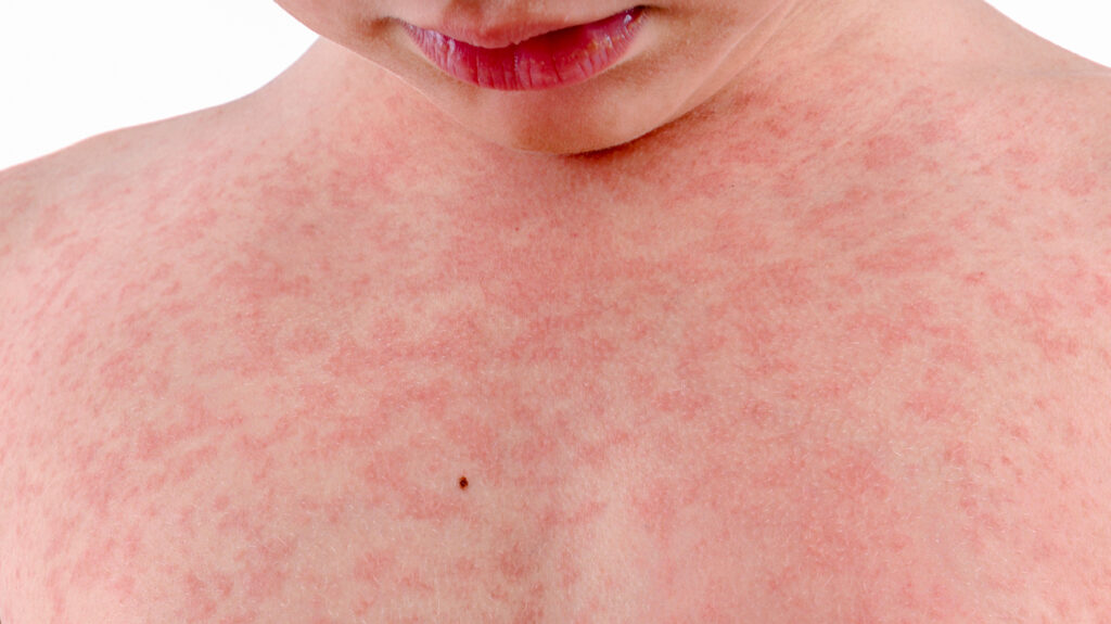 what viruses cause hives in toddlers