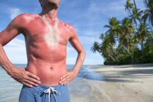 sunburn itchy after a week