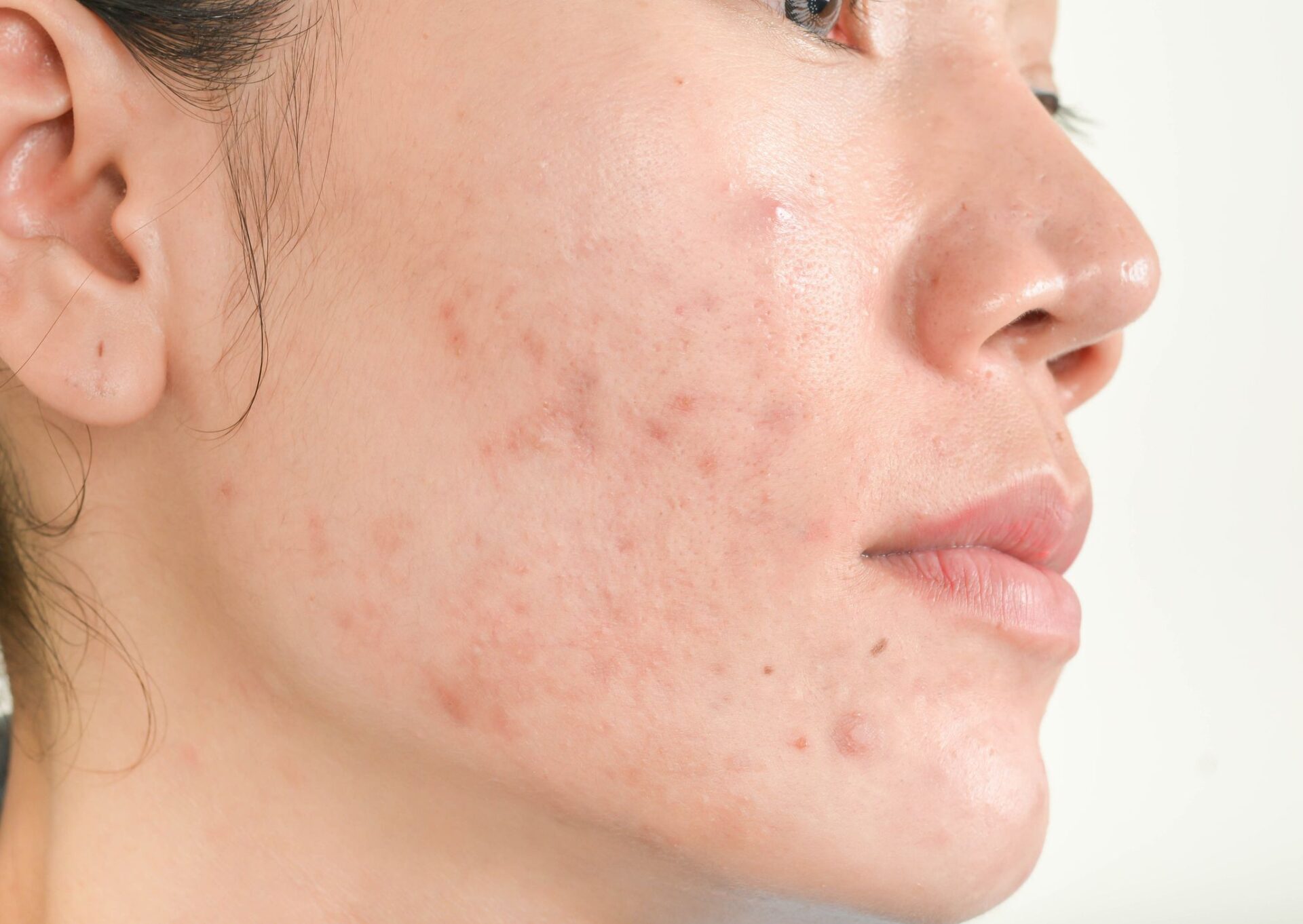 how-to-get-rid-of-acne-on-cheeks-and-chin-naturally