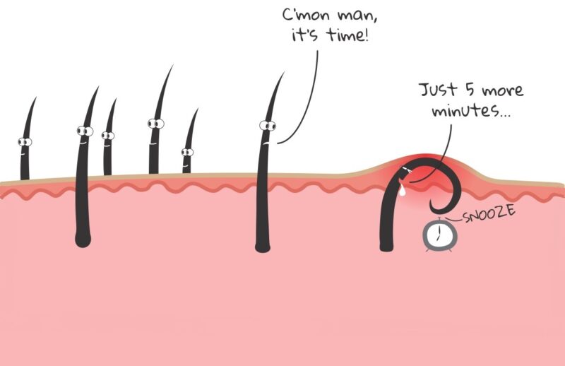 ingrown-hairs-nhs