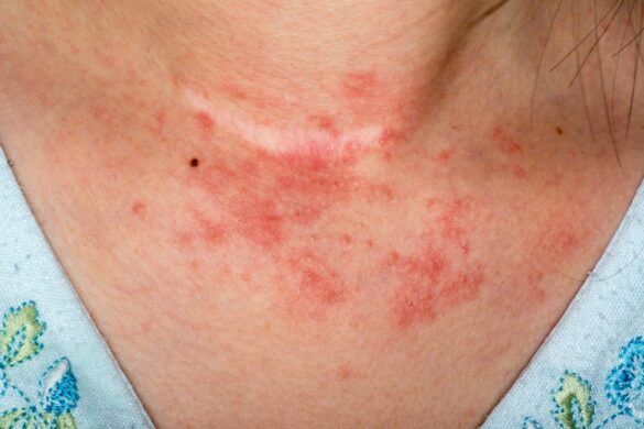 Instant Rash On Chest Rash on Chest Pictures, Causes, Symptoms, Remedies and Treatment ...