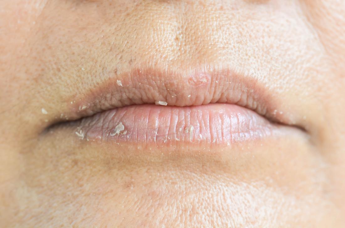 Lip Eczema Cause, Symptoms, on Baby, How to Treat, Cure