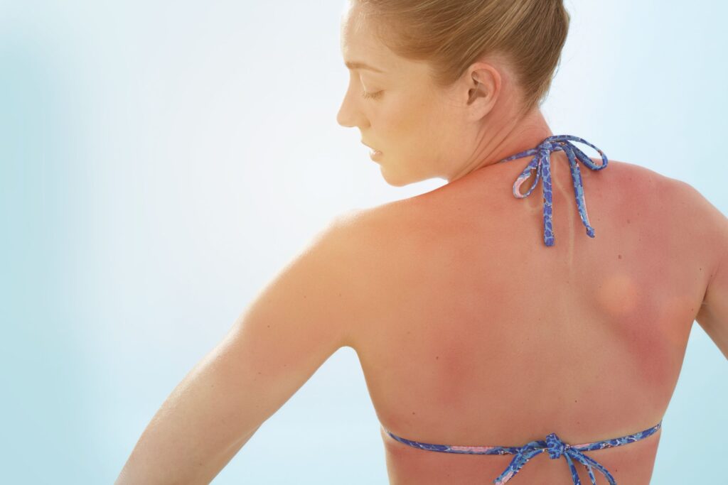 sunburn-with-blisters-treatment-symptoms-and-prevention