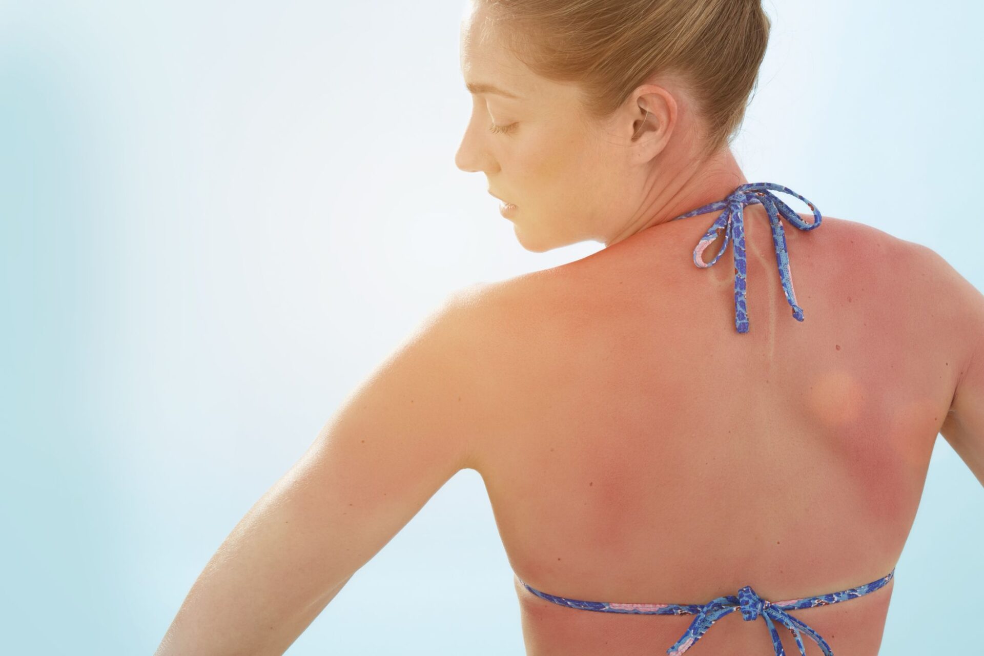 why-does-sunburn-itch-severe-unbearable-treatment-of-itchy-sunburn-american-celiac