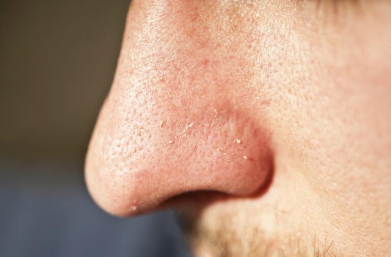 large-pores-on-nose-big-enlarged-how-to-get-rid-treat-or-shrink