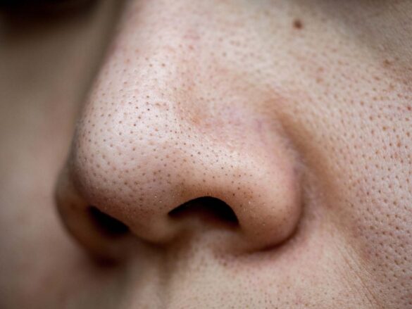 how to get rid of big pores on nose fast