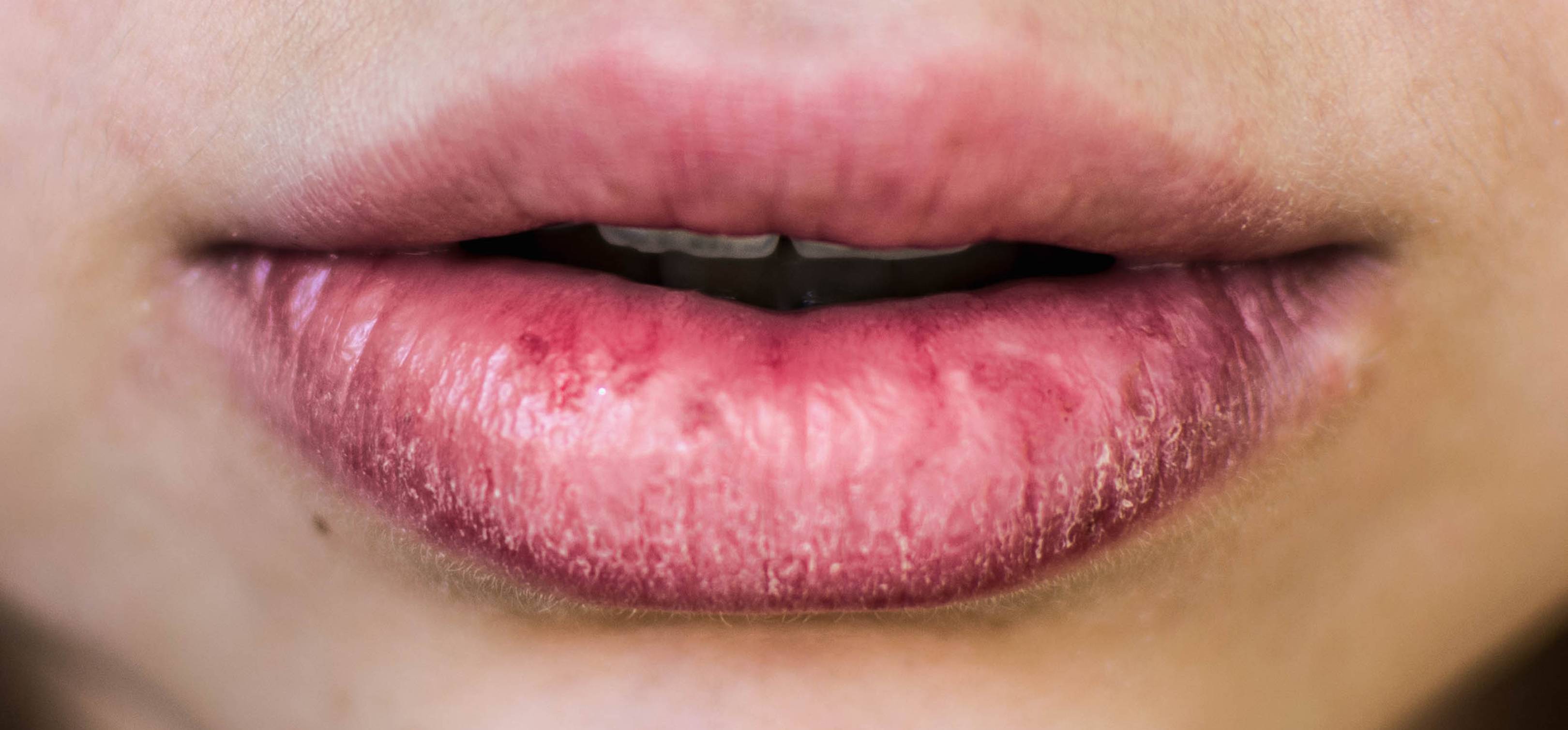 bump-on-lips-not-painful-a-cold-sore-white-red-tiny-remedies