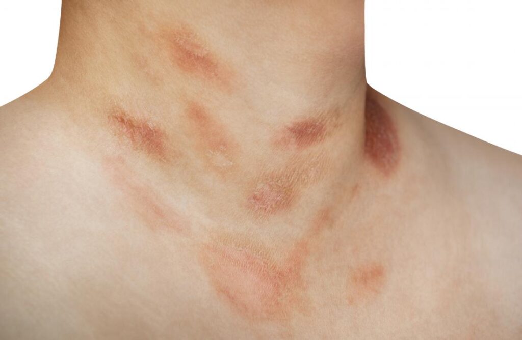 Rash On Chest Pictures Causes Symptoms Remedies And Treatment