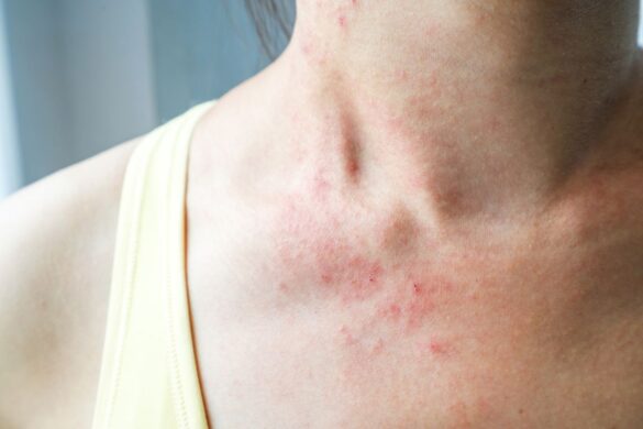 Rash On Neck Meaning Causes Itchy Red Bumpy Rash Diagnosis And 