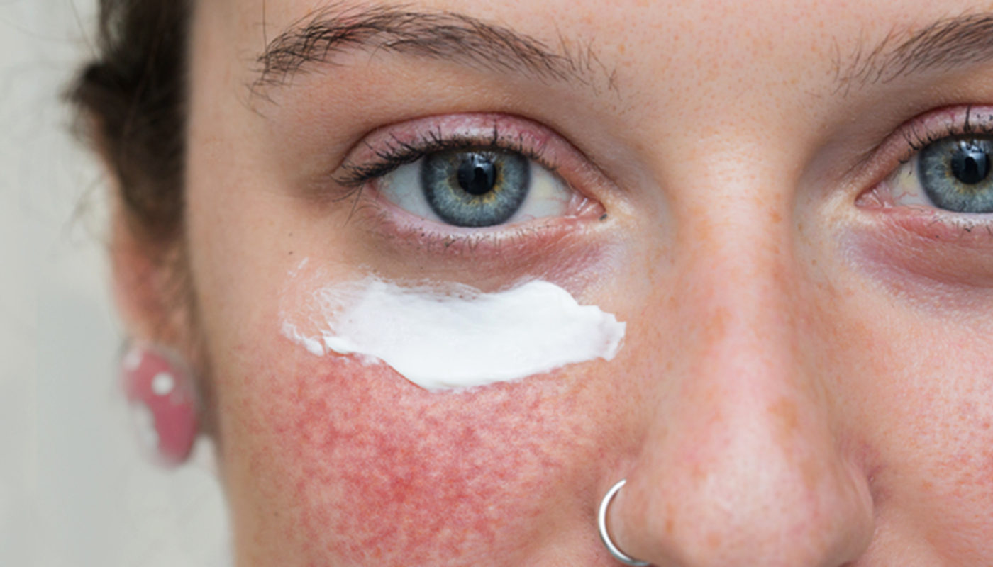 Redness Around Nose Causes And How To Get Rid Of Red Dry Skin On Nose American Celiac 