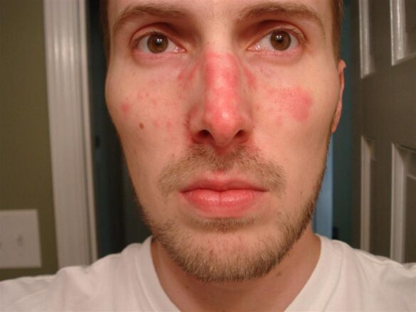 Redness Around Nose Causes And How To Get Rid Of Red Dry Skin On Nose