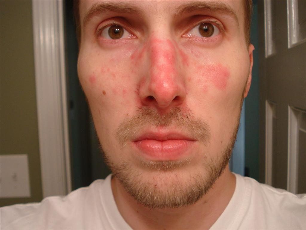 burning-rash-on-face