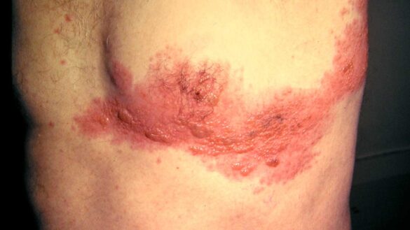 Shingles In Chest Rash on Chest Pictures, Causes, Symptoms, Remedies and Treatment ...