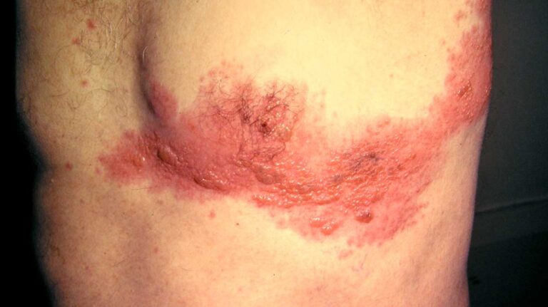Rash on Chest Pictures, Causes, Symptoms, Remedies and Treatment ...