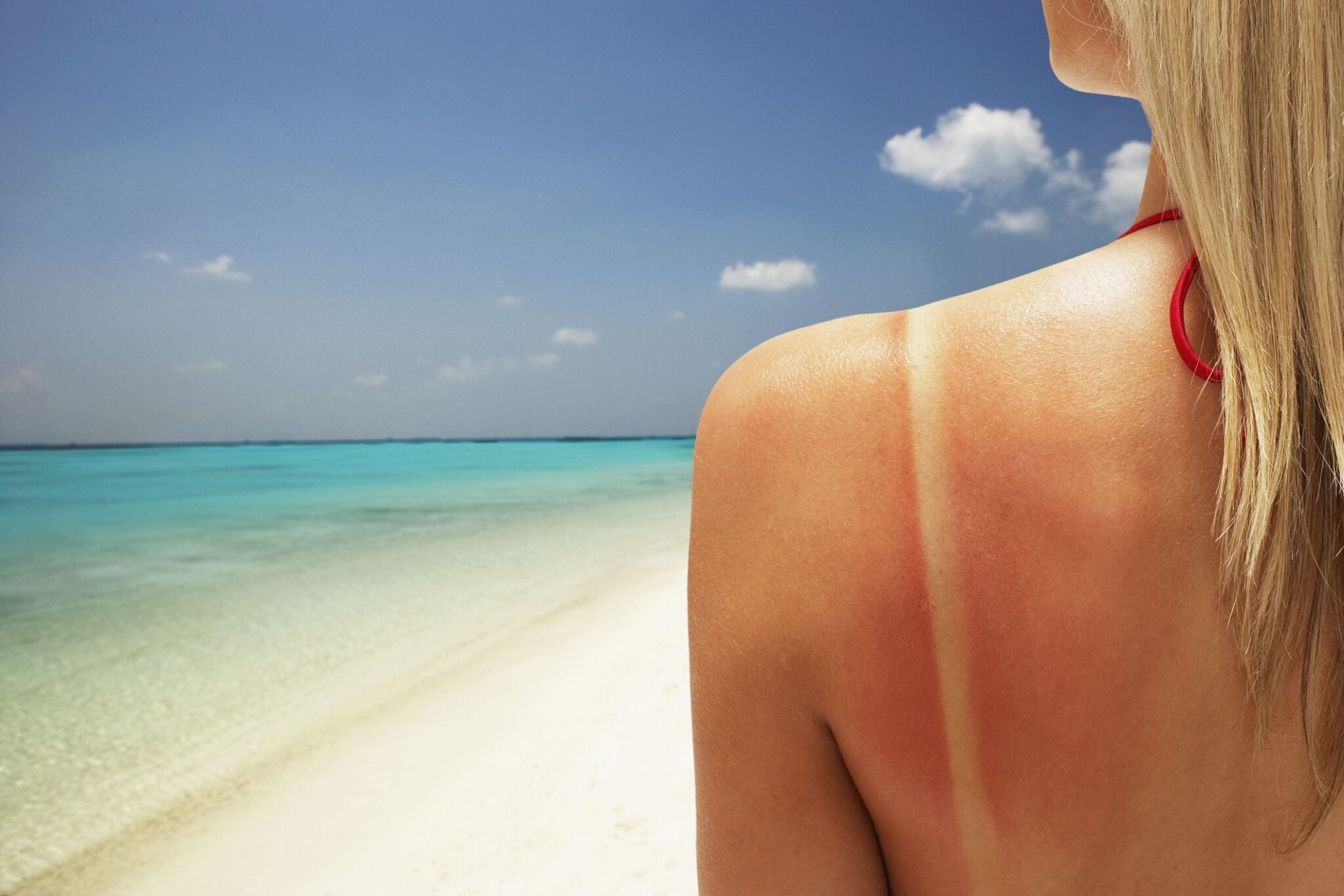 Why Does Sunburn Itch Severe Unbearable And Treatment Of Itchy Sunburn American Celiac