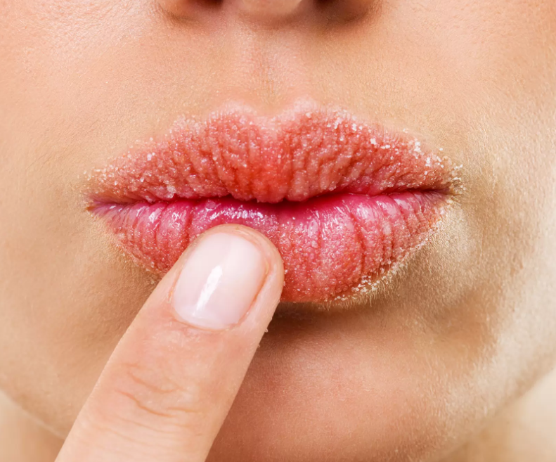 chapped-lips-causes-treatments-remedies-newborn-severely-cracked-lips-or-cheilitis