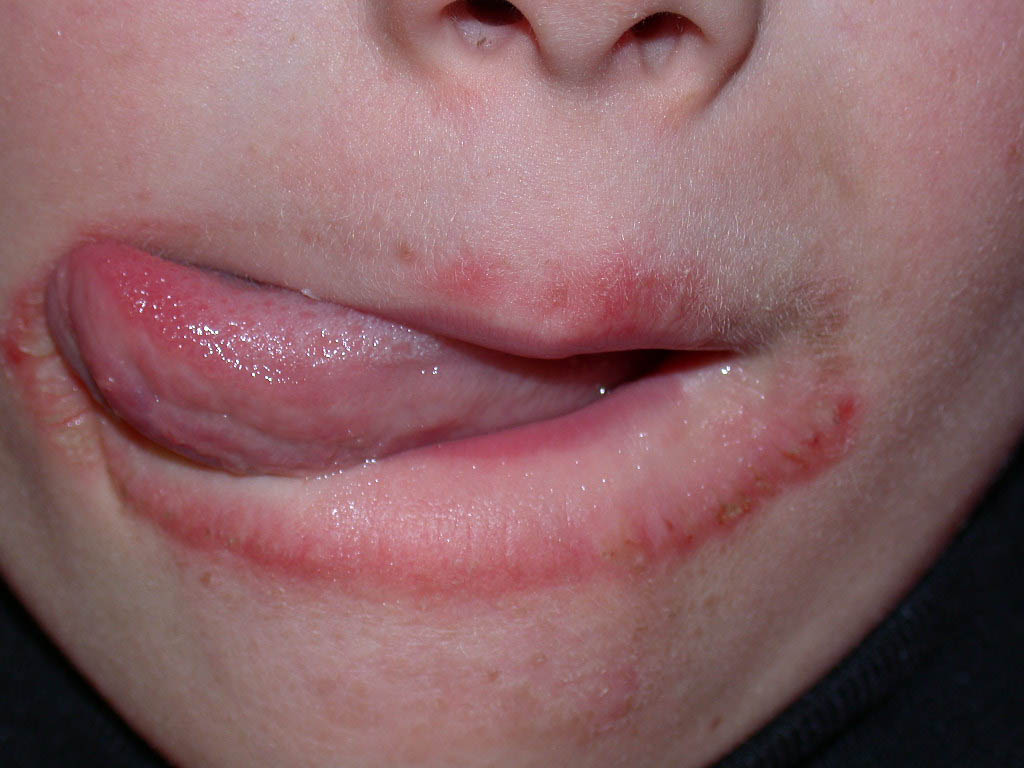 Red Rash Under Bottom Lip Toddler