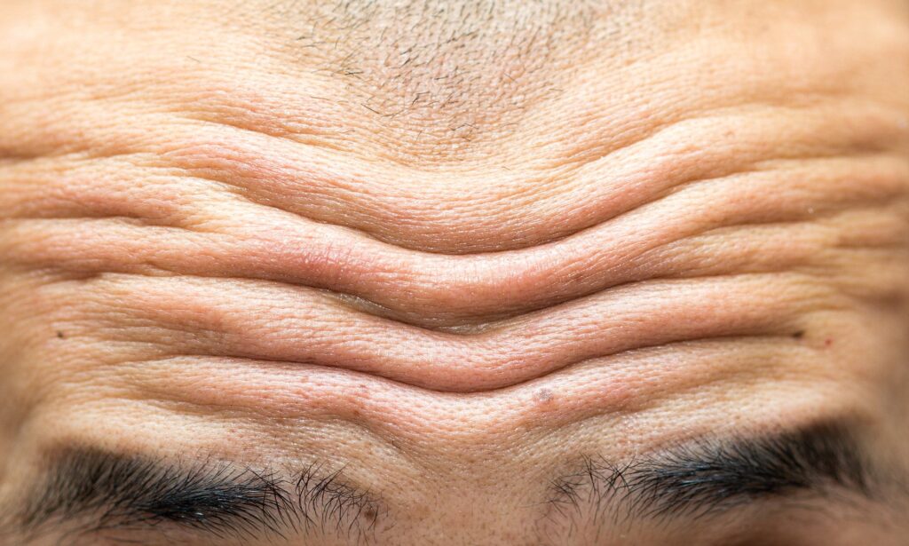 forehead-wrinkles-causes-at-18-20-25-get-rid-forehead-treatments