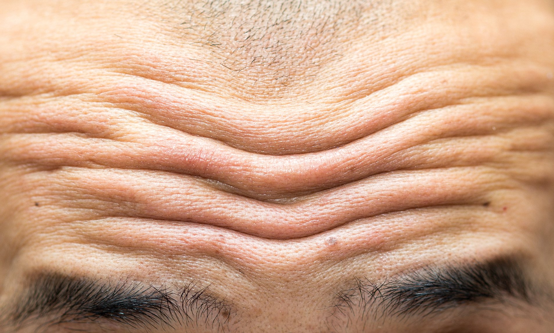 how-to-get-rid-of-lines-on-forehead-treatment-not-botox