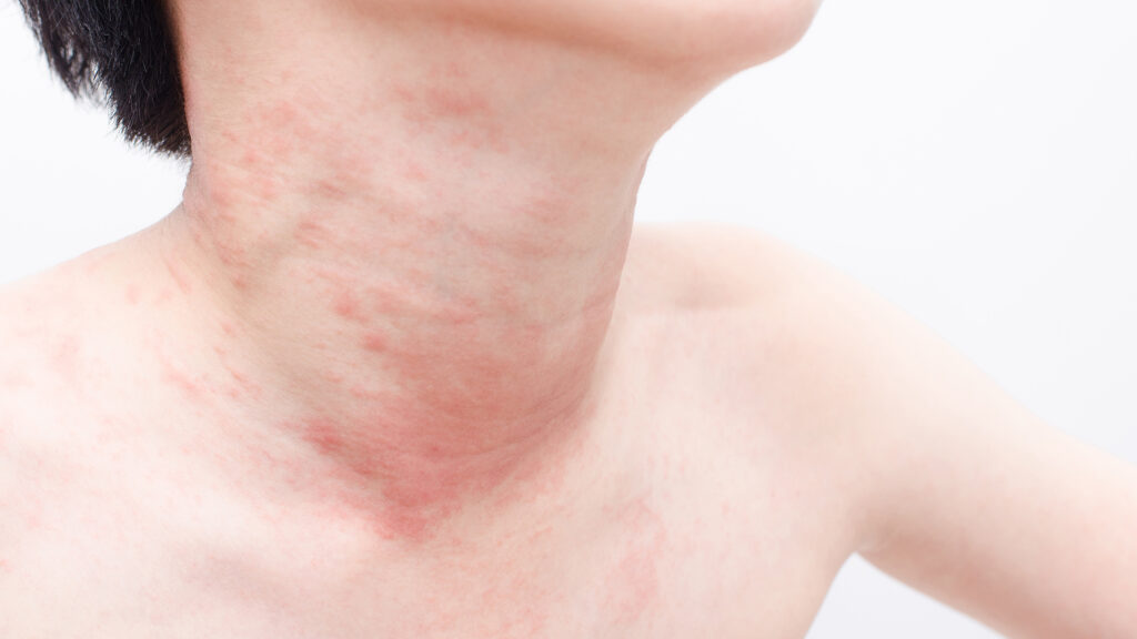 skin rashes that itch lines