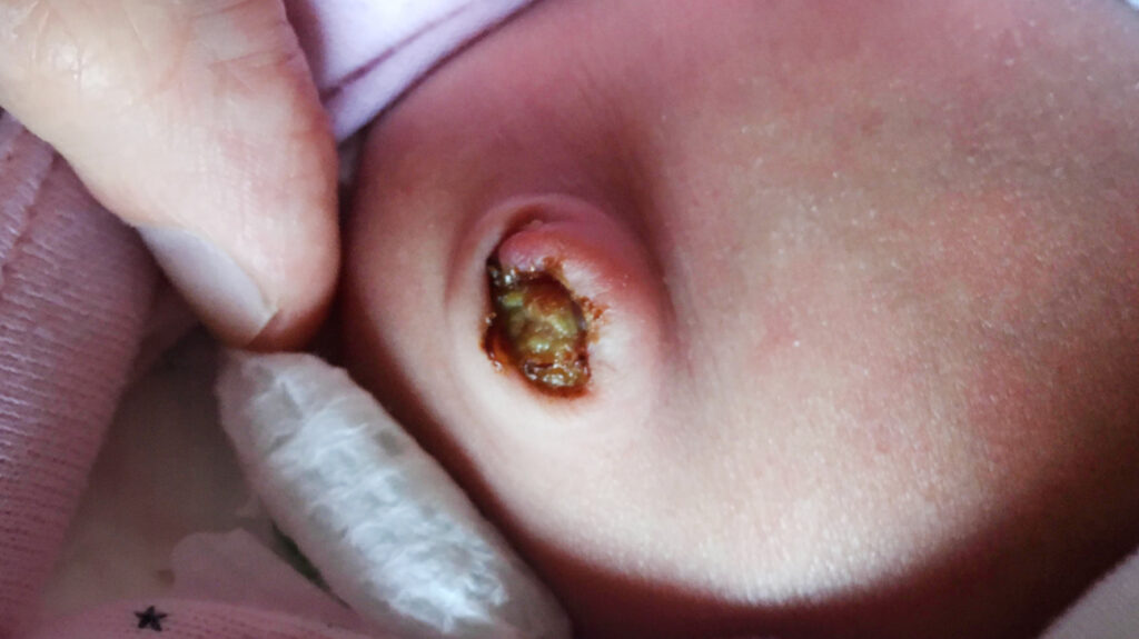 Belly Button Discharge - Causes, Yeast, Smelly White ...