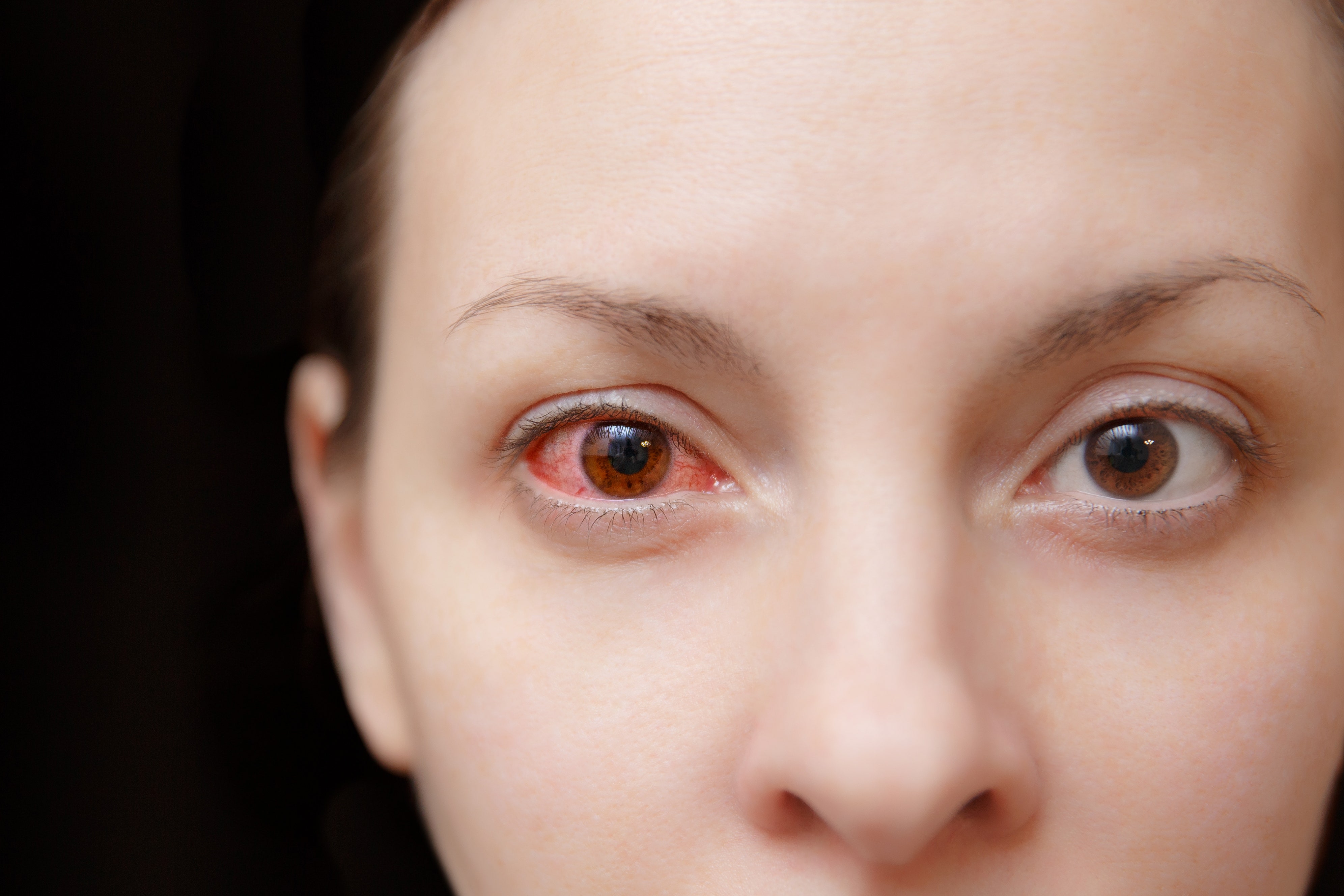 are antibiotic eye drops over the counter