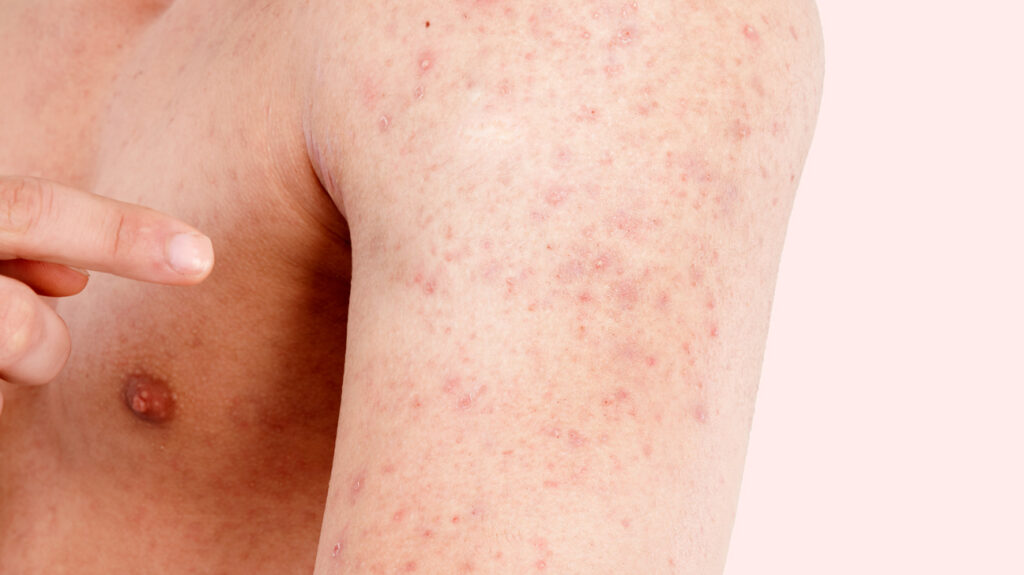 Bumps on Arms Little, Red, White and on Back of Arms American Celiac