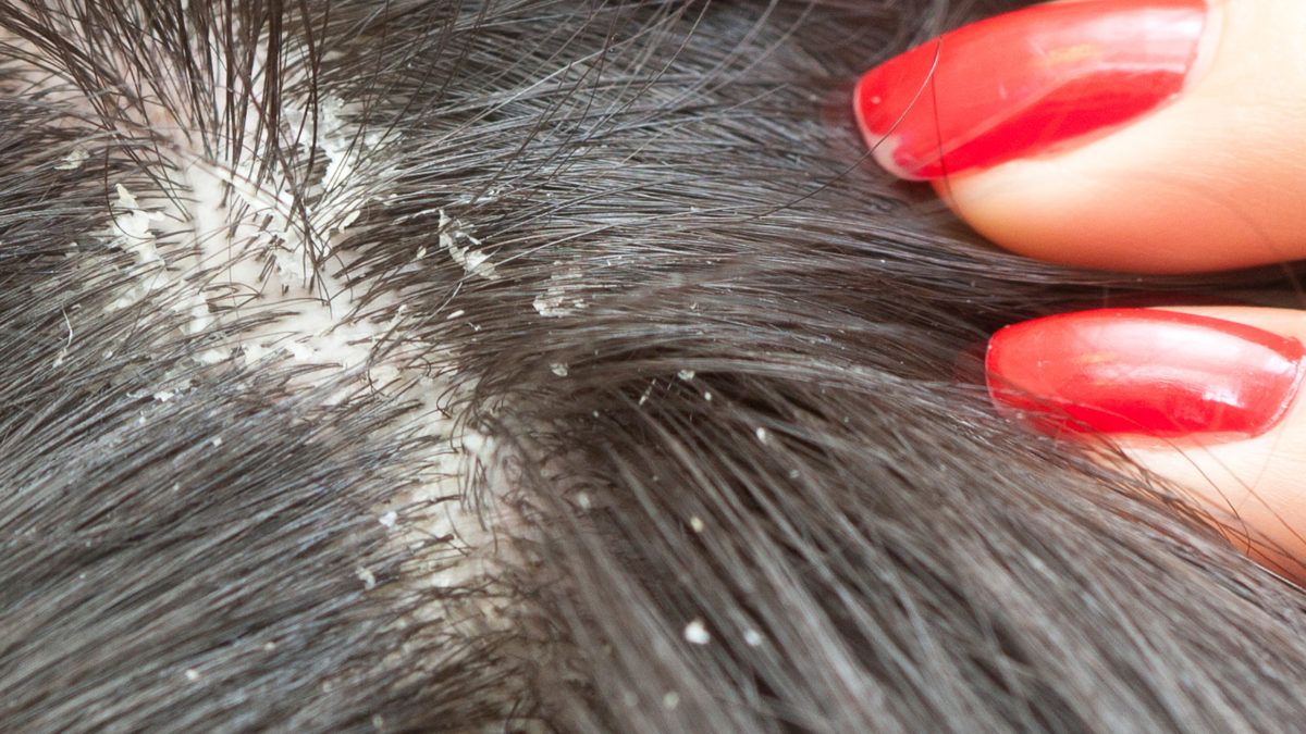 Dry Scalp Causes Like Eczema And Psoriasis Symptoms Treatments