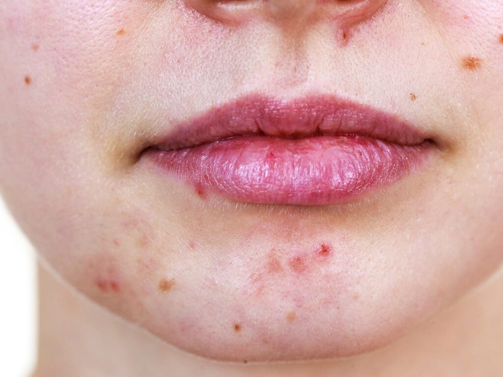 Hormonal, Stress, Pregnancy Chin Acne Cystic, Causes, Treatments