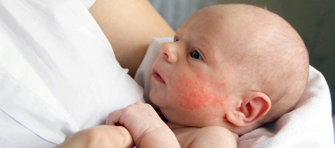 Itchy, NonItchy Rash on Baby Face Causes, Symptoms, Relief American