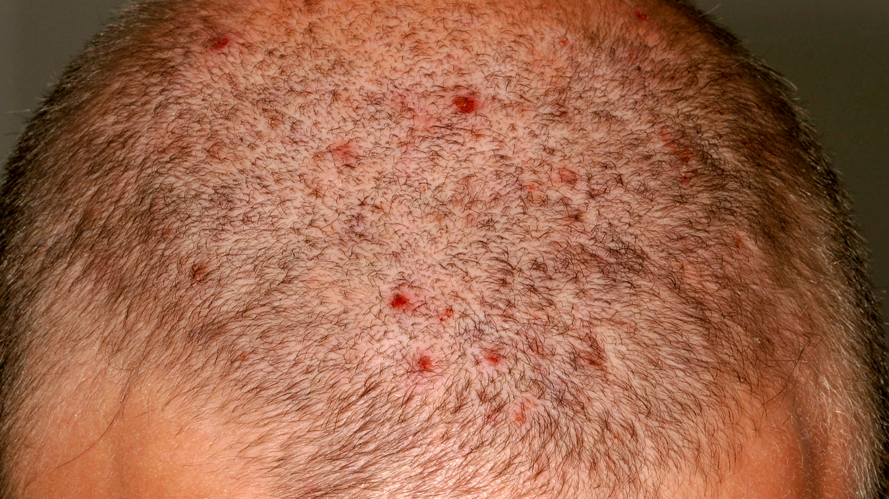 small-spot-on-scalp-not-itchy