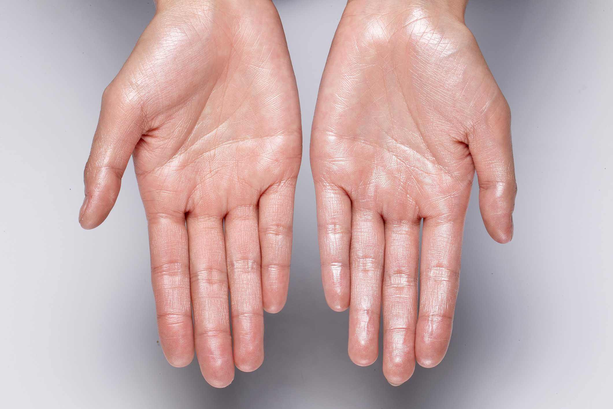 Sweaty Palms and Hands Causes, Cures, Surgery, Remedies, During ...