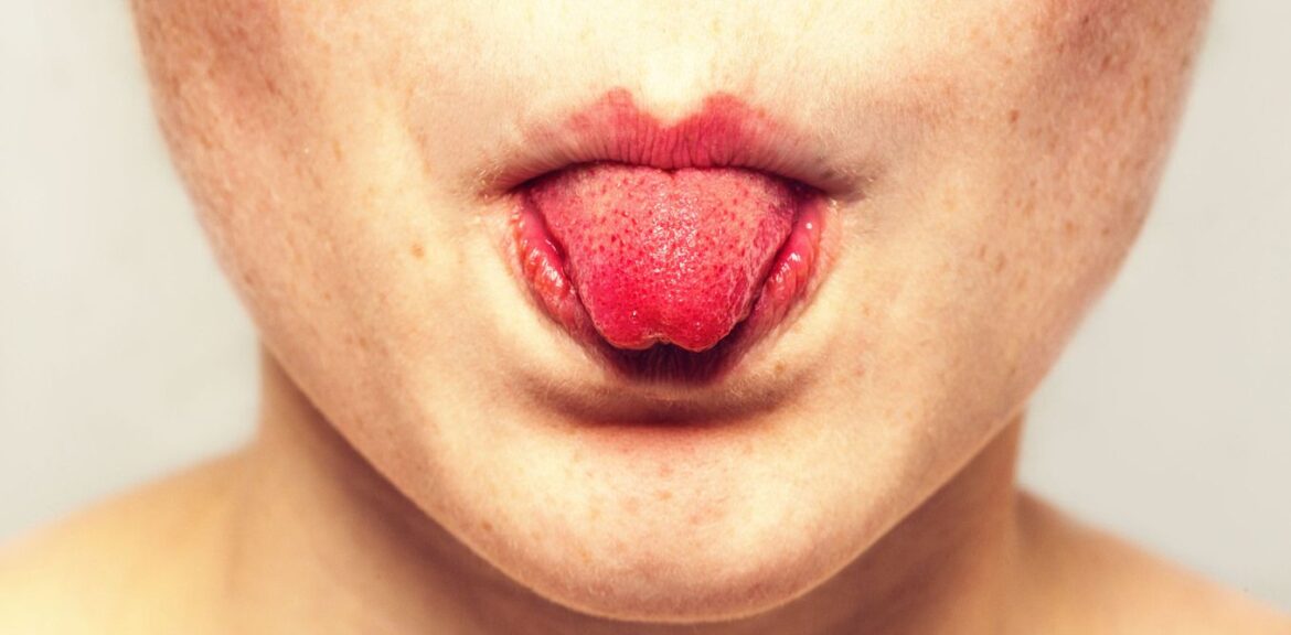 inflamed-enlarged-or-swollen-taste-buds-on-back-tip-or-side-of-tongue