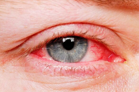 Eyelid Redness Causes, Symptoms, Inflamed, Dry Itchy Swollen Red