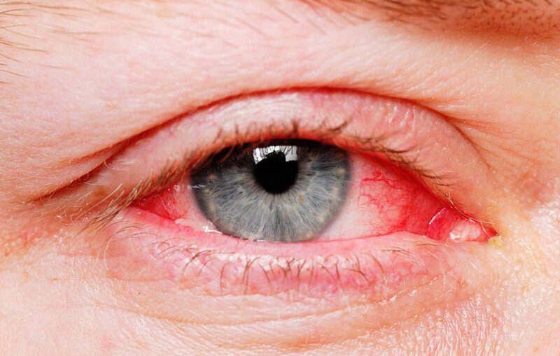 Cause and How to Get Rid of Red Bloodshot Eyes Fast American Celiac