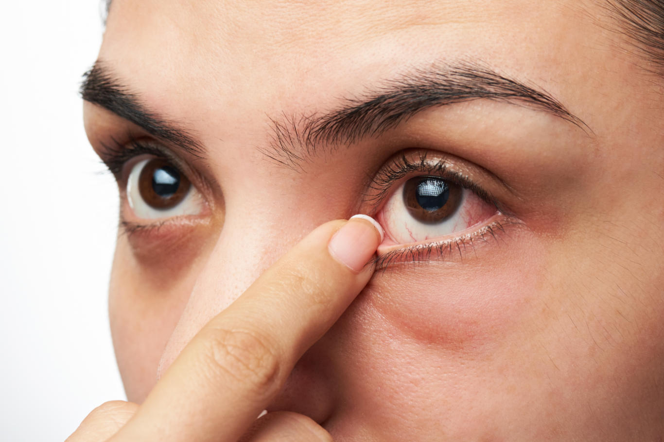 Red, Watery, Dry Itchy Eyes and Eyelids Causes and Cures American Celiac