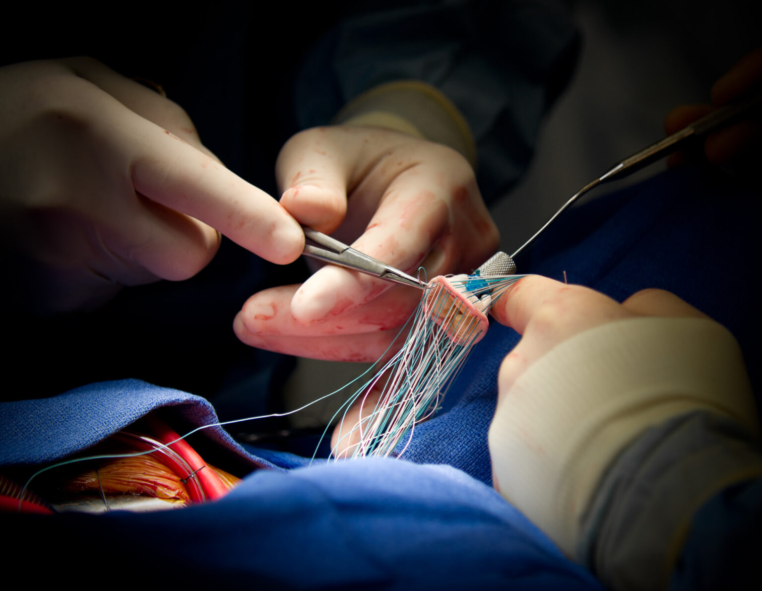 Prosthetic Heart Valves Are Generally Prepared From Bovine Tissues And 