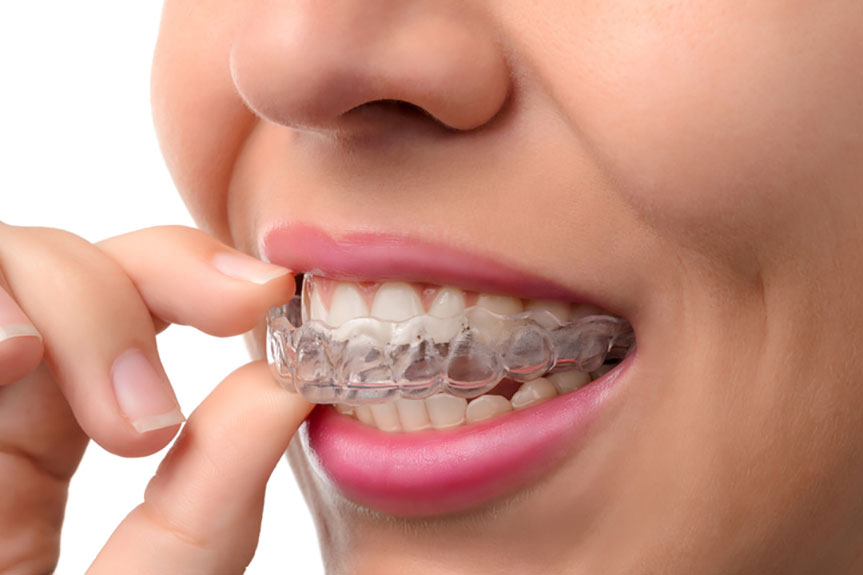 Do Invisible Braces Work Faster? American Celiac