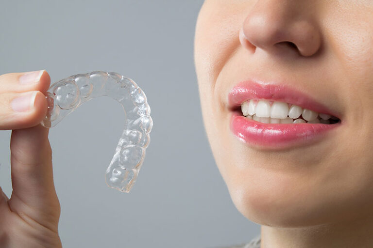 Do Invisible Braces Work Faster? American Celiac