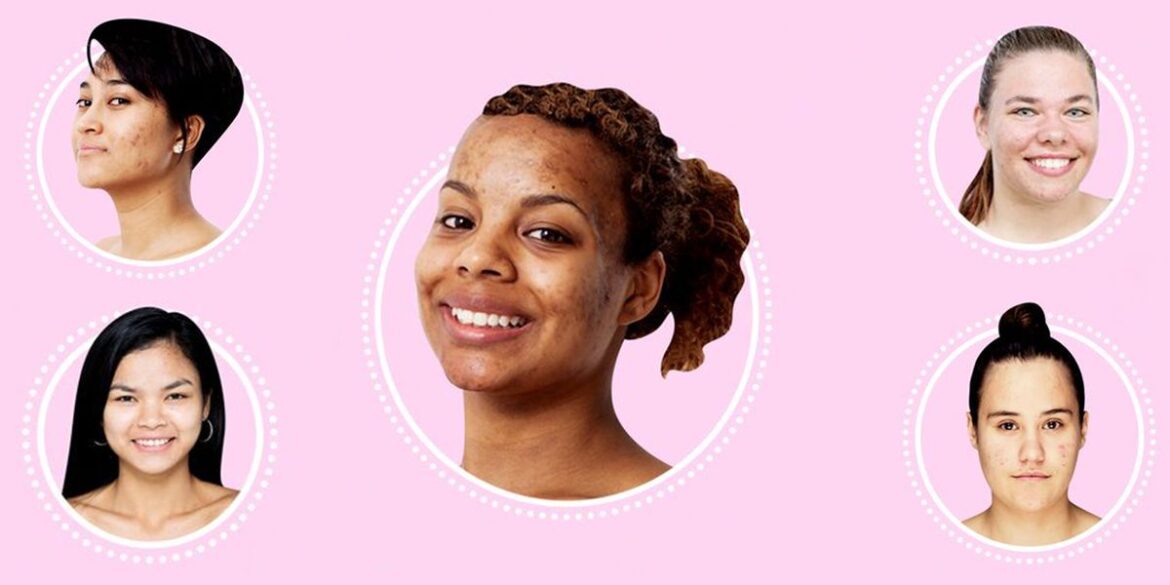 Why Cystic Acne Is So Tough to Treat American Celiac