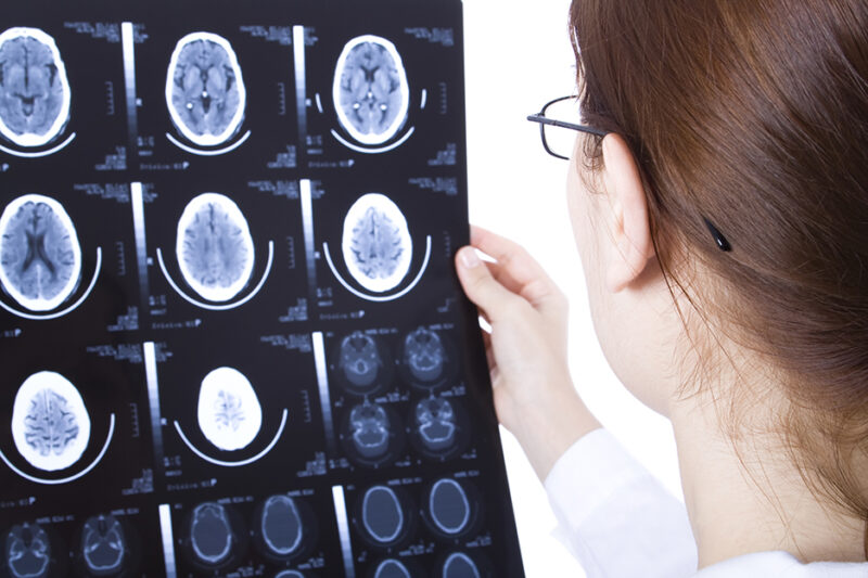 How to Prevent Seizures 5 Tips to Keep in Mind American Celiac