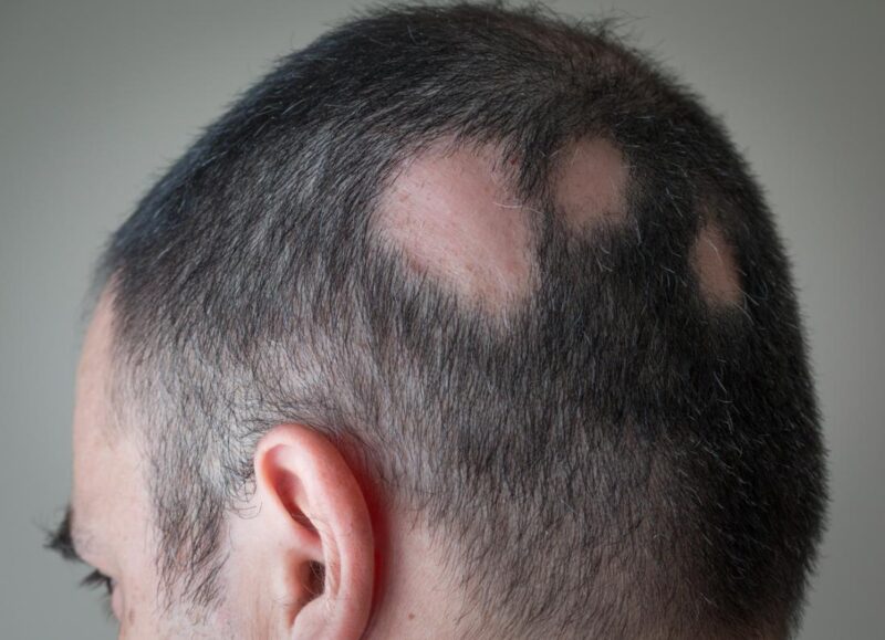 3 Tips to Cover and Treat Alopecia Areata American Celiac
