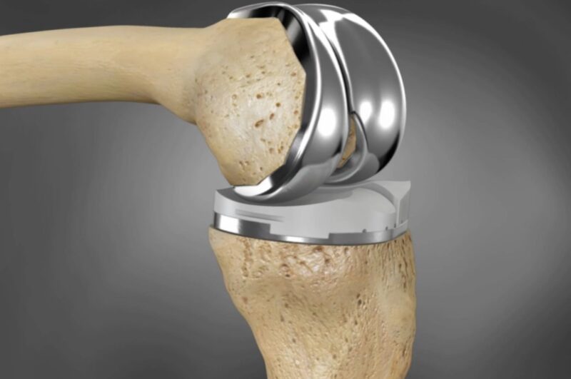 Implant Selection Knee Replacement